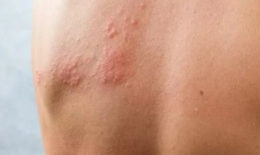 Herpes-Zóster: Sintomas, Prevenção e Aumento dos Casos no Pós-Pandemia