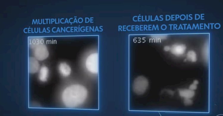Brasileiro Revoluciona o Combate ao Câncer com Nova Terapia que 'Superaquece' Células Tumorais!