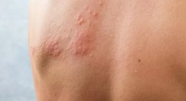 Herpes-Zóster: Sintomas, Prevenção e Aumento dos Casos no Pós-Pandemia
