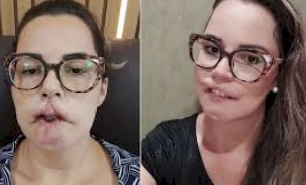 Influenciadora digital sofre complicações após harmonização facial com substância não absorvível