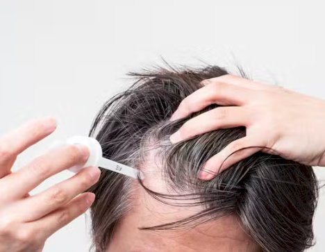 Anvisa alerta para risco de crescimento anormal de pelos em bebês expostos ao minoxidil