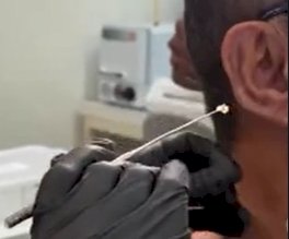 CERA DO OUVIDO PODE AJUDAR A ANTECIPAR DIAGNÓSTICO DO CÂNCER, APONTAM PESQUISADORES DA UFG